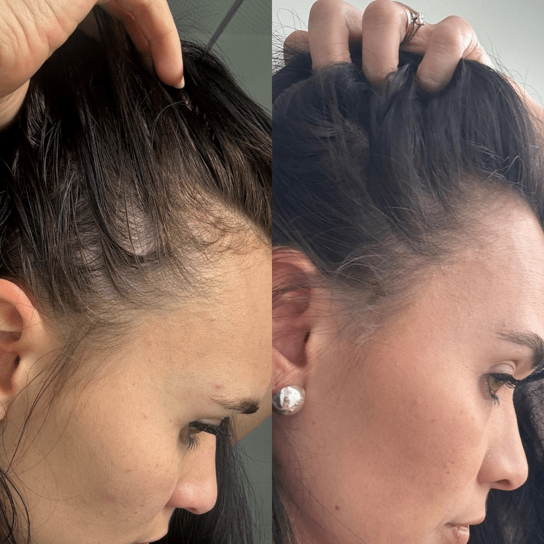 EZZ Hair Growth Spray DUO - Best Hair Growth Spray Products EZZ OFFICIAL